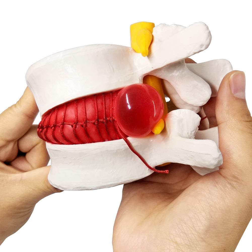 Human Herniated Disc Model, Anatomical Herniated Lumbar Vertebrae Disc Prolapse Model for Medical Teaching Learning, Kids Learning Education Display Toolning, Kids Learning Education Display Tool